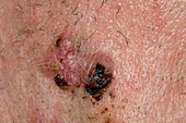 Basal cell carcinoma on the face