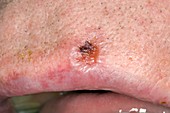 Basal cell carcinoma on the lip