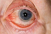 Chronic blepharitis of the eye