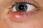 Meibomian abscess in lower eyelid