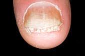 Psoriasis of a finger nail