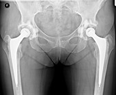 'Hip joint replacement (bilateral),X-ray