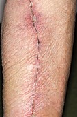 Leg vein scar for heart surgery