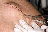 Unstapling wound on arm (image 7 of 7)
