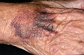Hand bruise in patient on warfarin