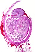 Cancerous kidney tumour,light micrograph