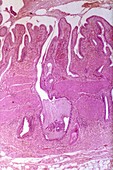 Bile duct cancer,light micrograph
