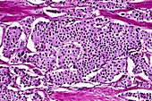 Endocrine tumour,light micrograph