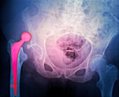 'Dislocated hip prosthesis,X-ray'