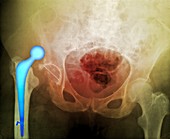 'Dislocated hip prosthesis,X-ray'