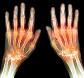 'Rheumatoid arthritis of the hands,X-ray