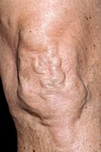 Varicose veins over the knee