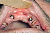 Severe dental decay of the teeth