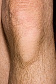 Bursitis of the knee