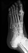 'Osteoarthritis in the big toe,X-ray'