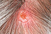 Squamous cell carcinoma of the scalp