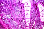 Lung cancer,light micrograph