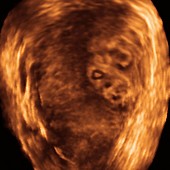 Chorion cancer,3-D ultrasound scan