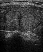 Thyroid nodules,light micrograph