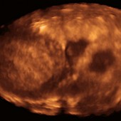 Ectopic pregnancy,ultrasound scan