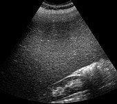 Enlarged spleen,ultrasound scan