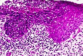 Penile skin cancer,light micrograph