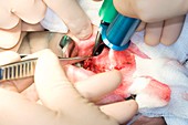 Mouth cancer surgery