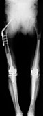 Hip and knee replacement,X-ray
