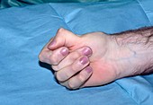 Rheumatoid arthritis