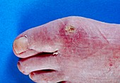 Scleroderma of the foot