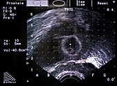 Prostate cancer radiotherapy scan