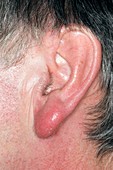 Cellulitis on the earlobe