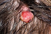 Pyogenic granuloma on the scalp