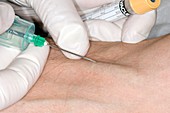 Inserting a syringe (venesection)