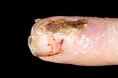 Skin cancer on finger