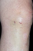 Knee wound after endoscopy