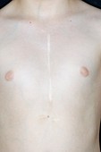 Chest scar from heart surgery