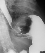 Stomach cancer,Barium X-ray