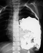 Diaphragmatic hernia,X-ray