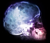 Bone cancer of the skull,X-ray