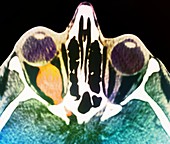 Optic nerve tumour,CT scan