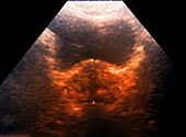 Prostate hypertrophy with tumour