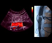 Stenosis in abdominal aorta,ultrasound