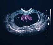 Nine week old foetus,ultrasound scan