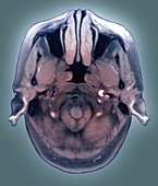 Haematoma in carotid artery,MRI scan