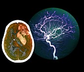 Brain haemorrhage from aneurysm,CT scan
