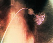 Treatment of lung aneurysms,X-ray