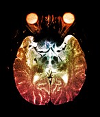 Parkinson's disease brain,MRI scan