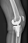 Total knee replacement,X-ray