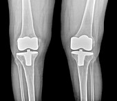 Bilateral total knee replacement,X-ray